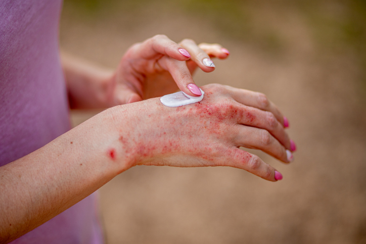 Cannabis médical et psoriasis : une option pour mieux gérer certains symptômes